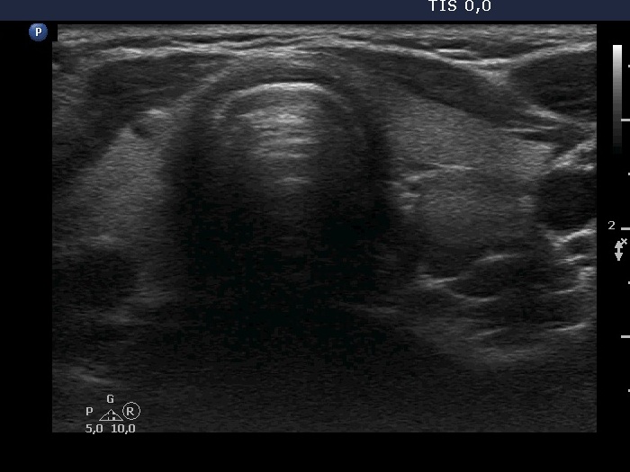 Right lobe, longitudinal scan
