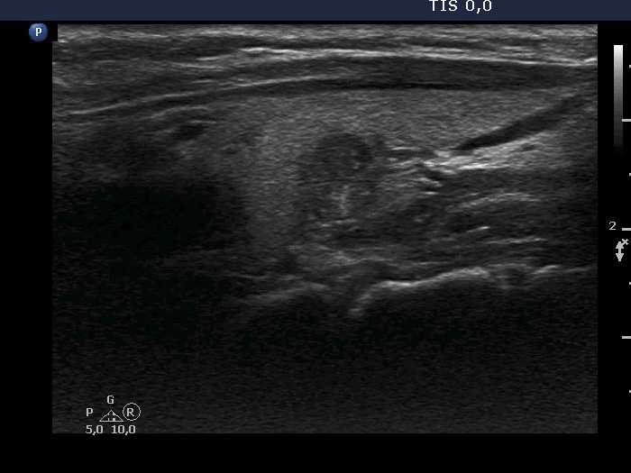 Right lobe, longitudinal scan