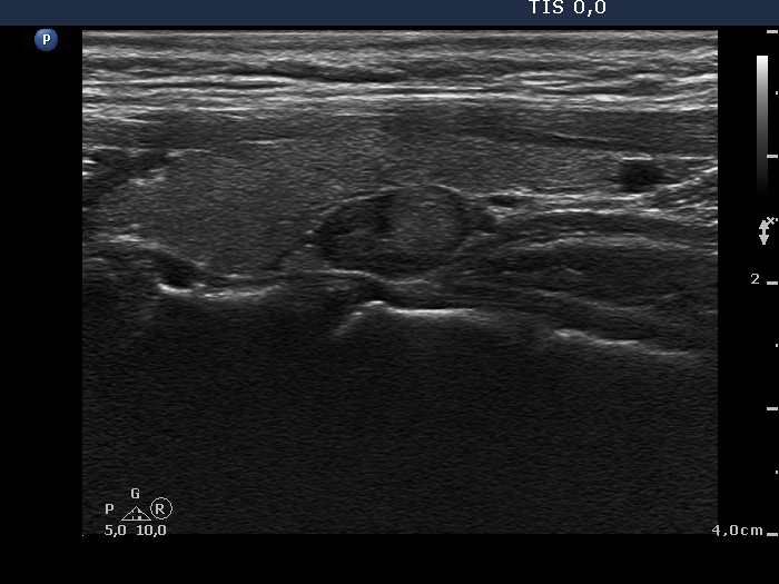 Right lobe, longitudinal scan