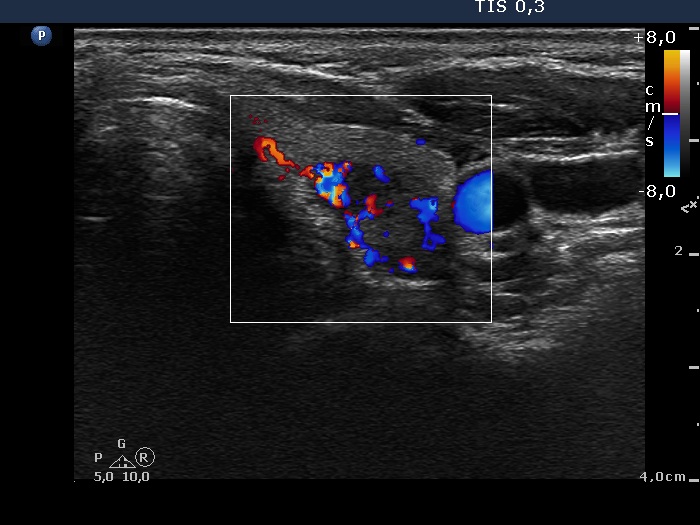 Right lobe, longitudinal scan