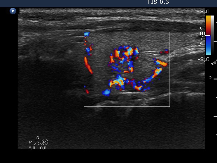 Right lobe, longitudinal scan