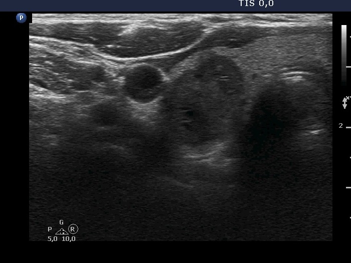 Right lobe, longitudinal scan