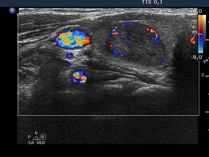 Right lobe, longitudinal scan