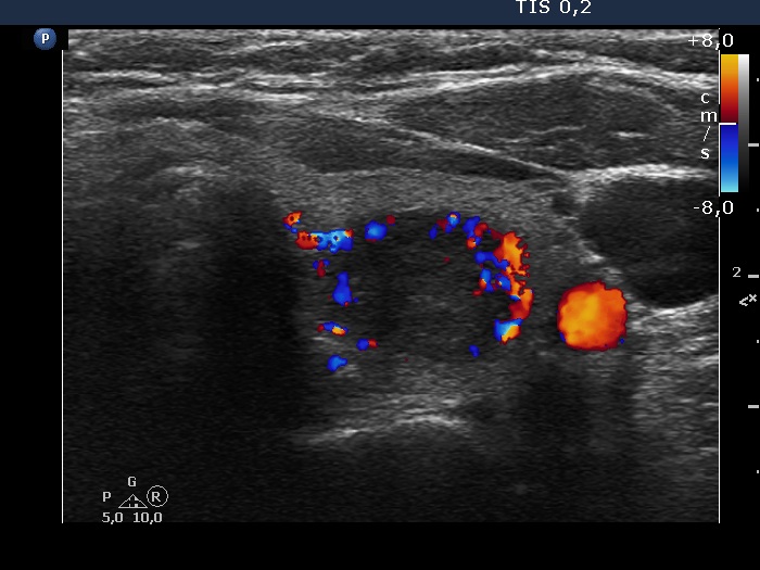 Right lobe, longitudinal scan