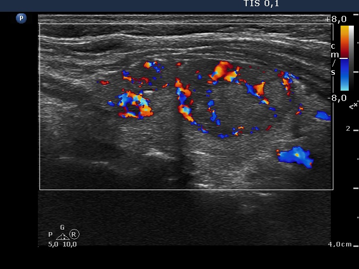 Right lobe, longitudinal scan