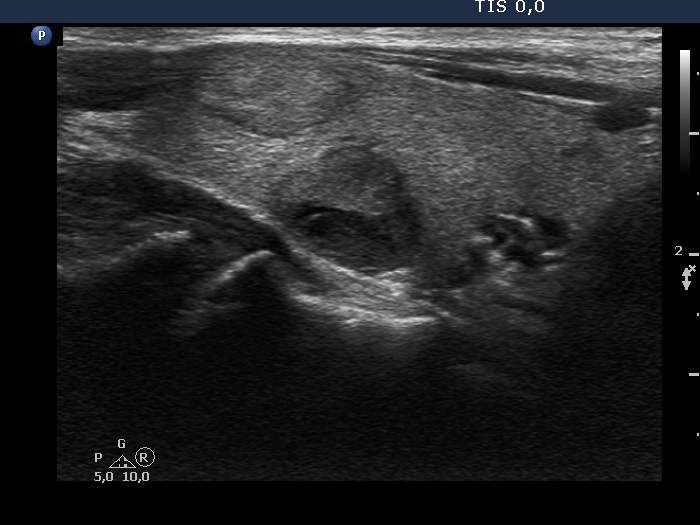 Right lobe, longitudinal scan