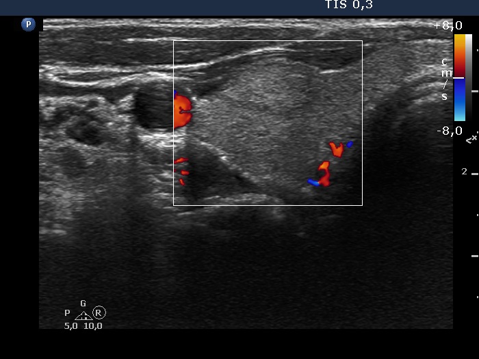 Right lobe, longitudinal scan