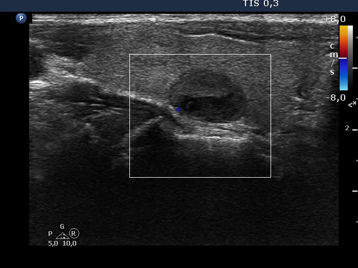 Right lobe, longitudinal scan