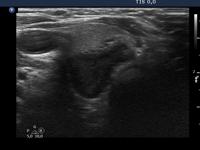Right lobe, longitudinal scan