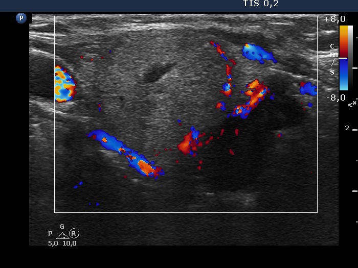 Right lobe, longitudinal scan