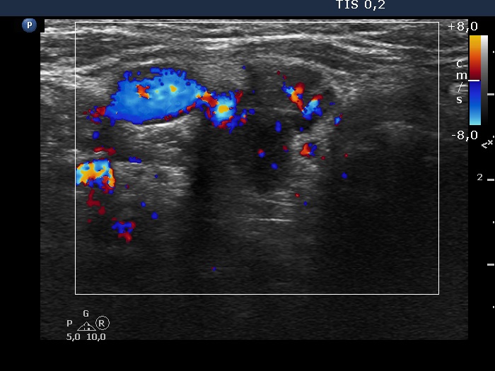 Right lobe, longitudinal scan
