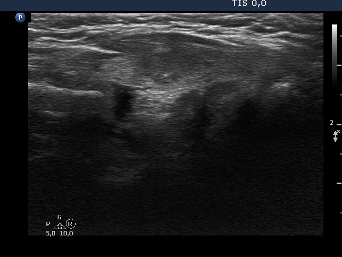 Right lobe, longitudinal scan