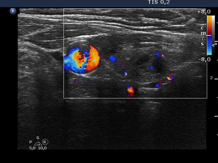 Right lobe, longitudinal scan