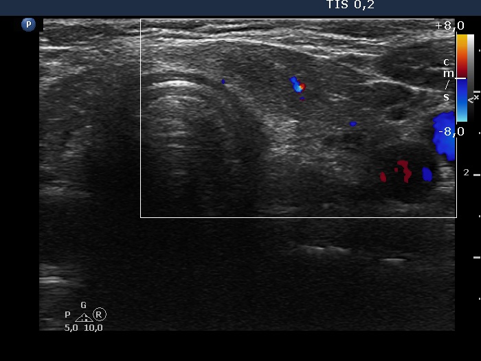 Right lobe, longitudinal scan