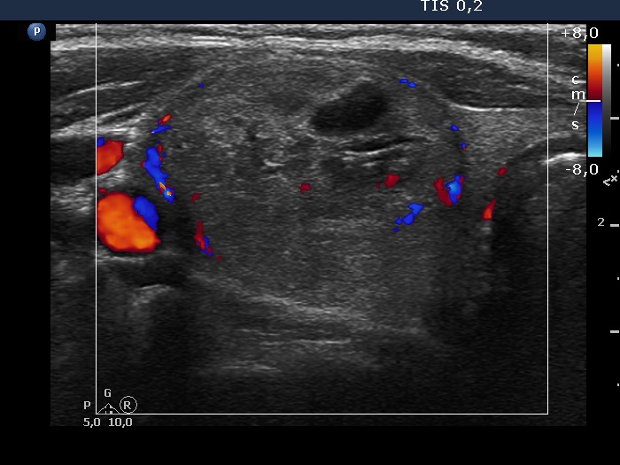 Right lobe, longitudinal scan