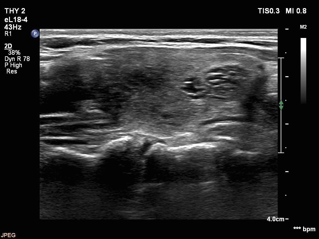 Right lobe, longitudinal scan
