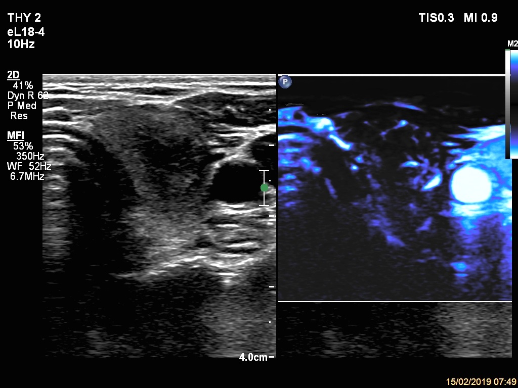 Right lobe, longitudinal scan