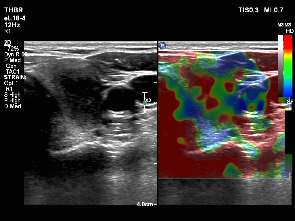 Right lobe, longitudinal scan