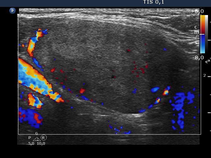 Right lobe, longitudinal scan