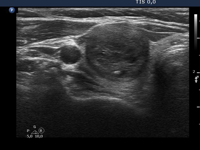 Right lobe, longitudinal scan