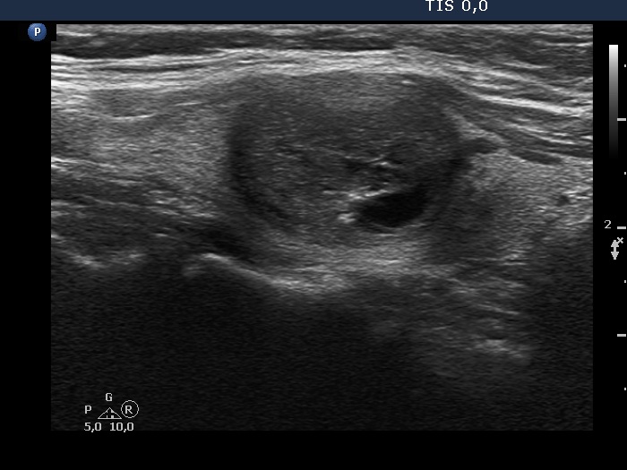 Right lobe, longitudinal scan