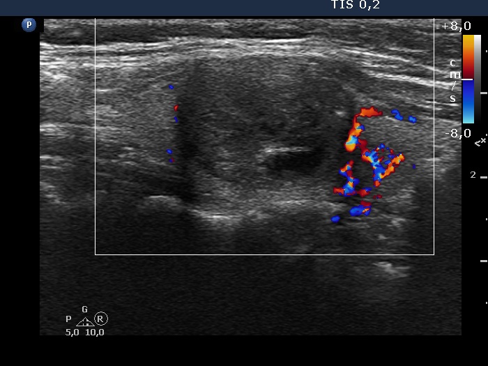 Right lobe, longitudinal scan