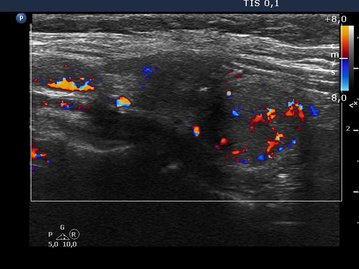 Right lobe, longitudinal scan