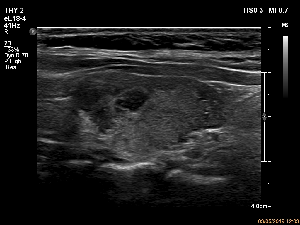 Right lobe, longitudinal scan