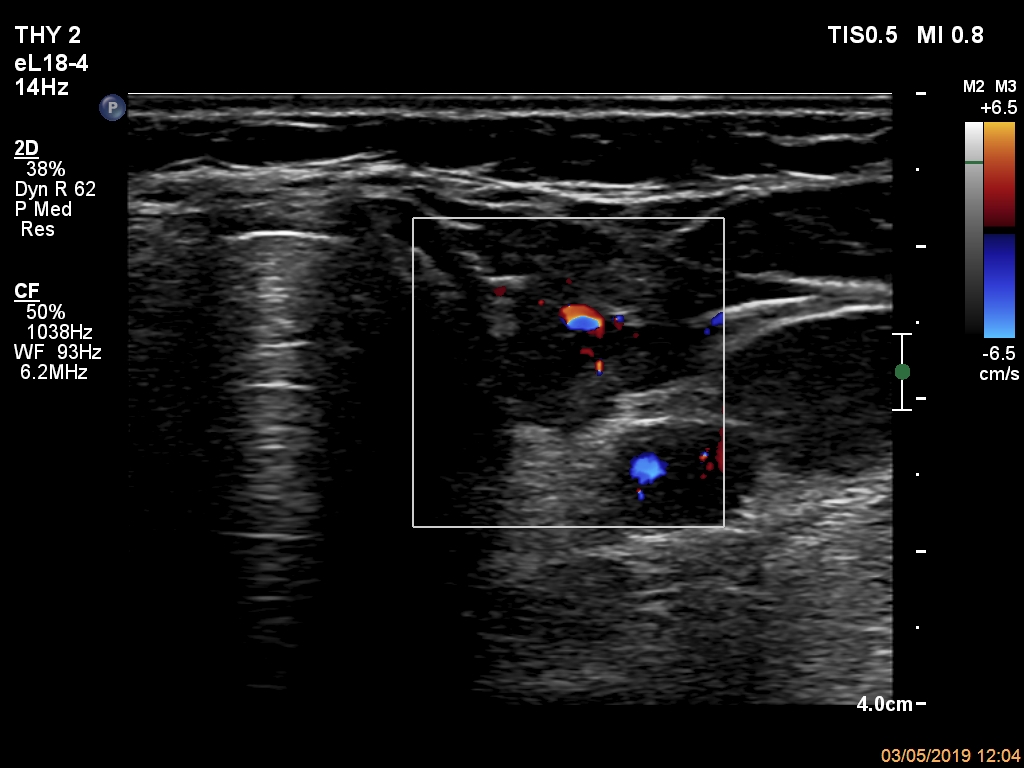 Right lobe, longitudinal scan