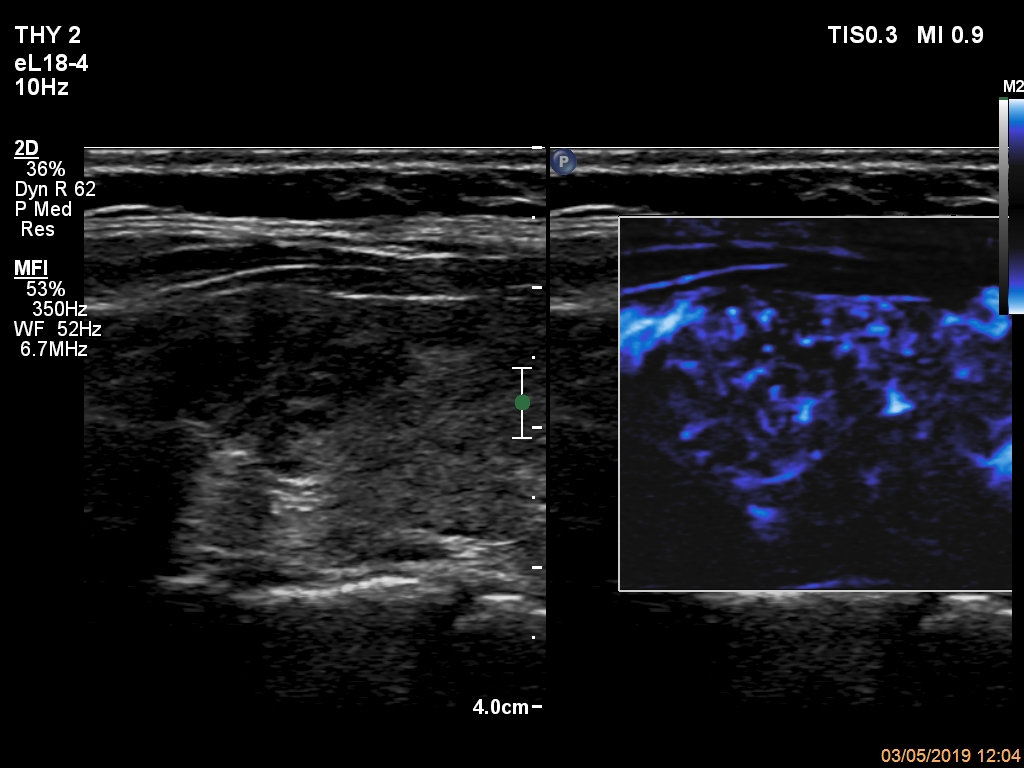 Right lobe, longitudinal scan