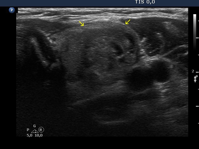 Right lobe, longitudinal scan
