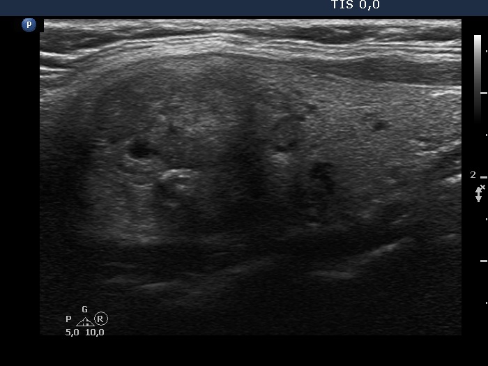 Right lobe, longitudinal scan