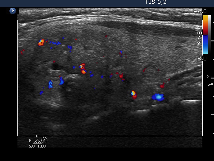 Right lobe, longitudinal scan