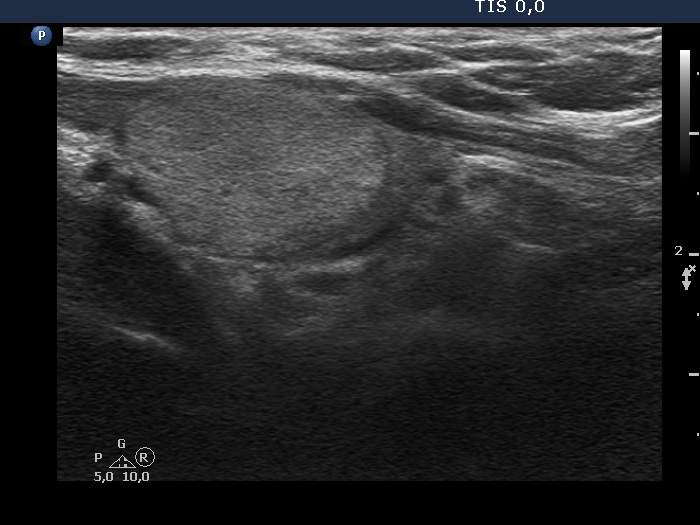 Right lobe, longitudinal scan