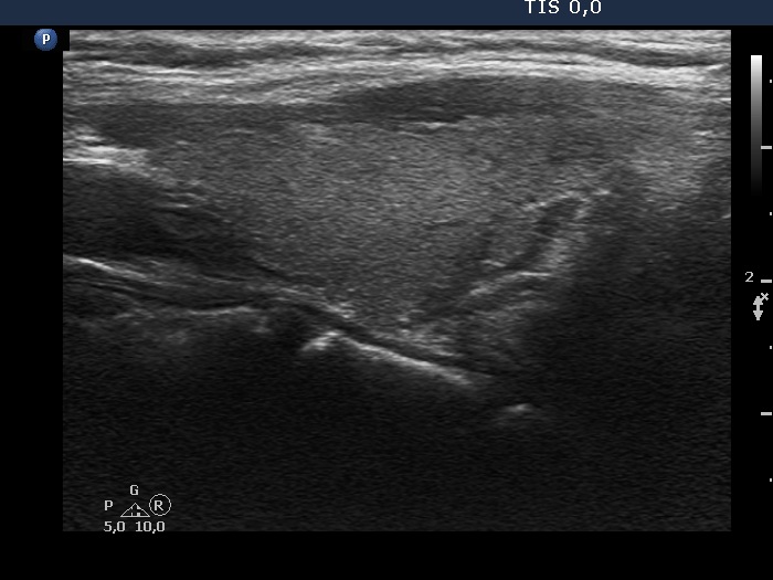 Right lobe, longitudinal scan