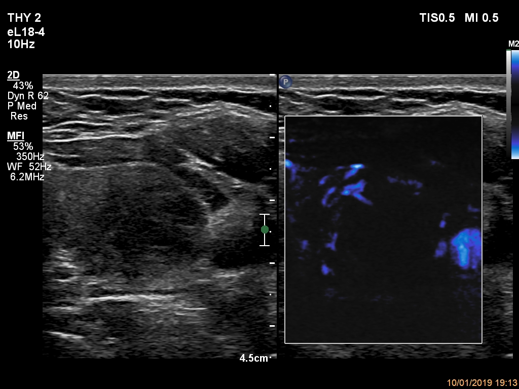 Right lobe, longitudinal scan