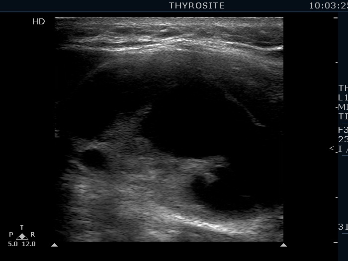 Right lobe, longitudinal scan