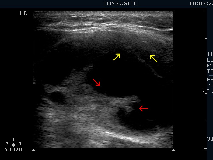 Right lobe, longitudinal scan