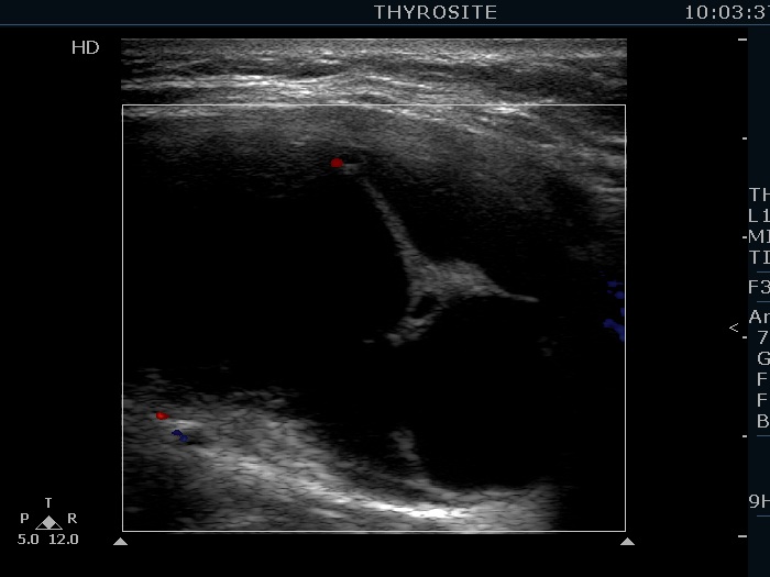 Right lobe, longitudinal scan