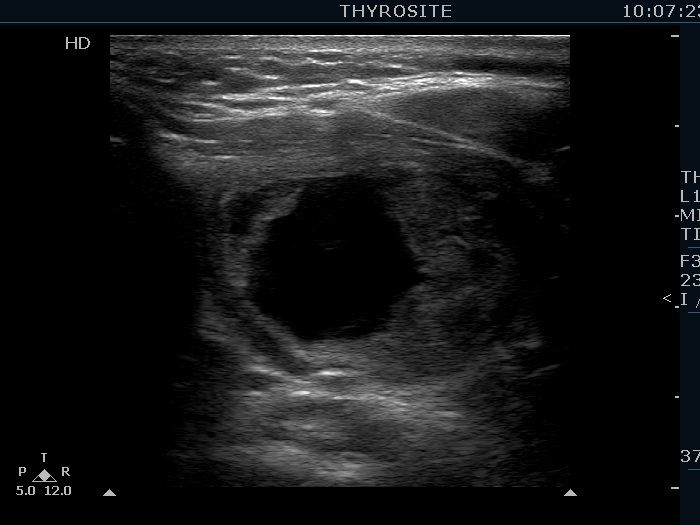 Right lobe, longitudinal scan