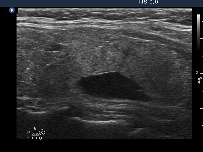 Right lobe, longitudinal scan