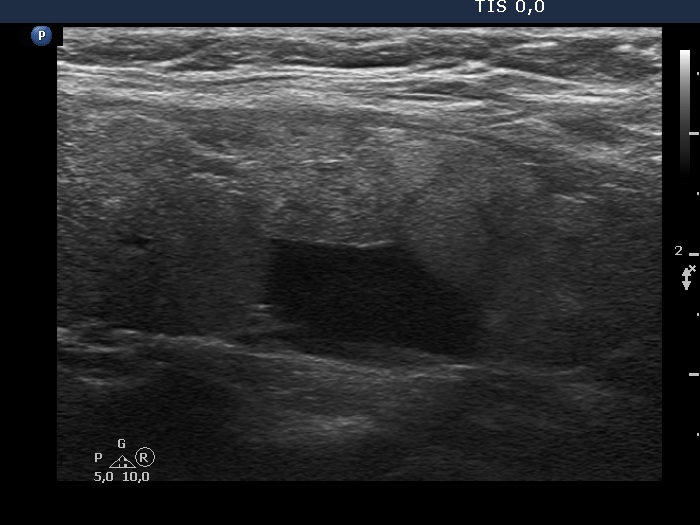 Right lobe, longitudinal scan
