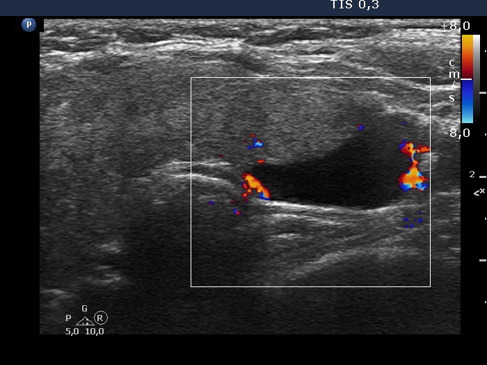 Right lobe, longitudinal scan