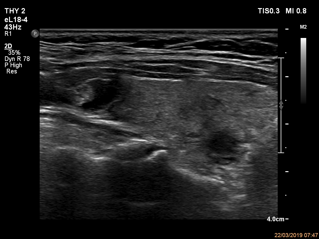 Right lobe, longitudinal scan