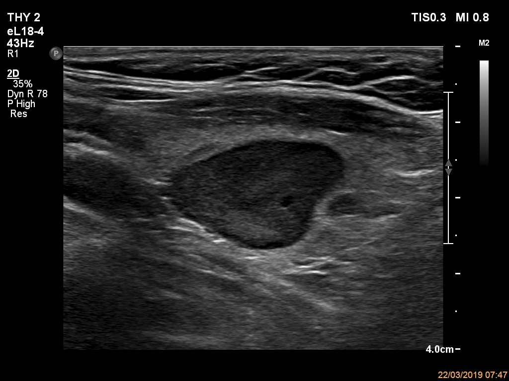 Right lobe, longitudinal scan