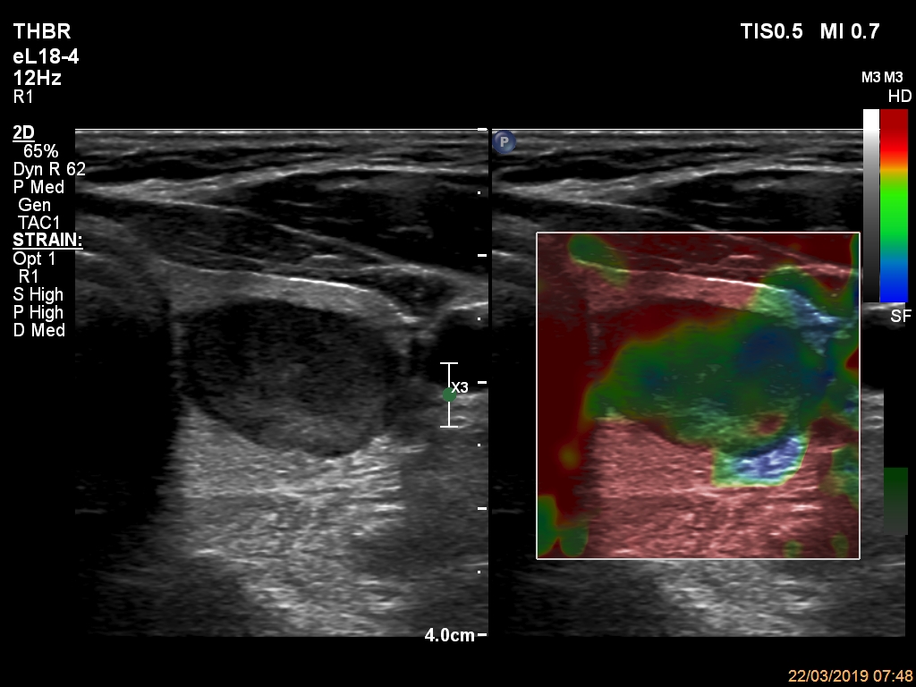 Right lobe, longitudinal scan