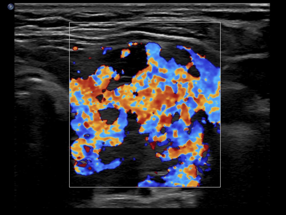 Right lobe, longitudinal scan