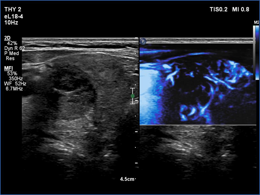 Right lobe, longitudinal scan