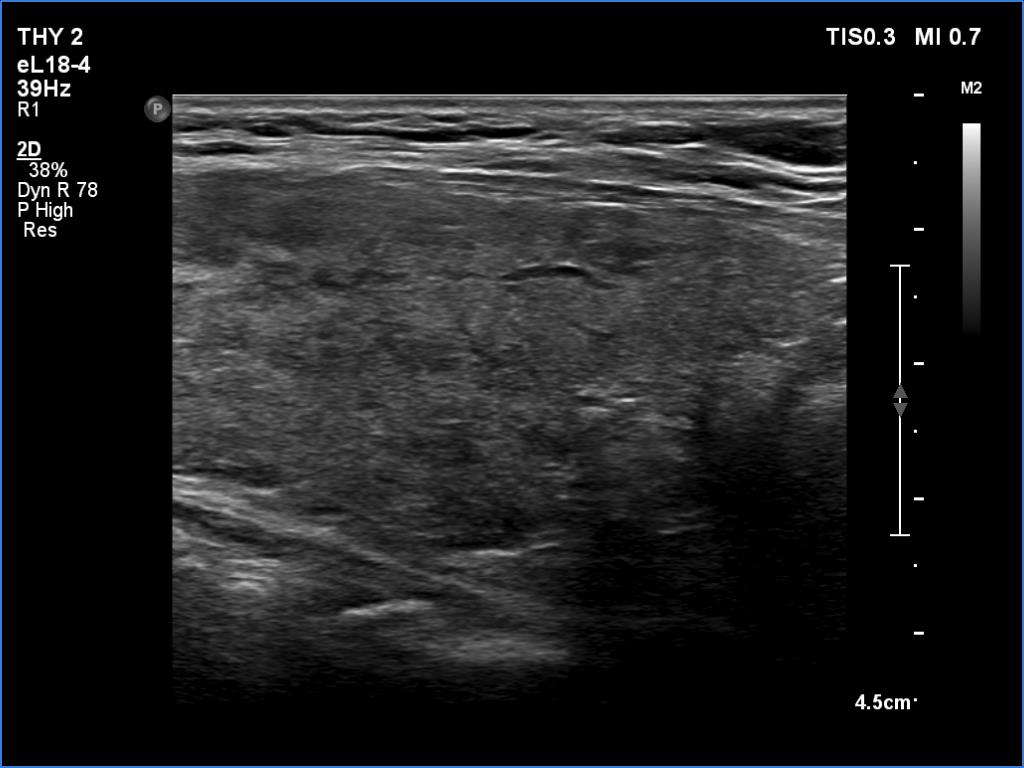 Right lobe, longitudinal scan