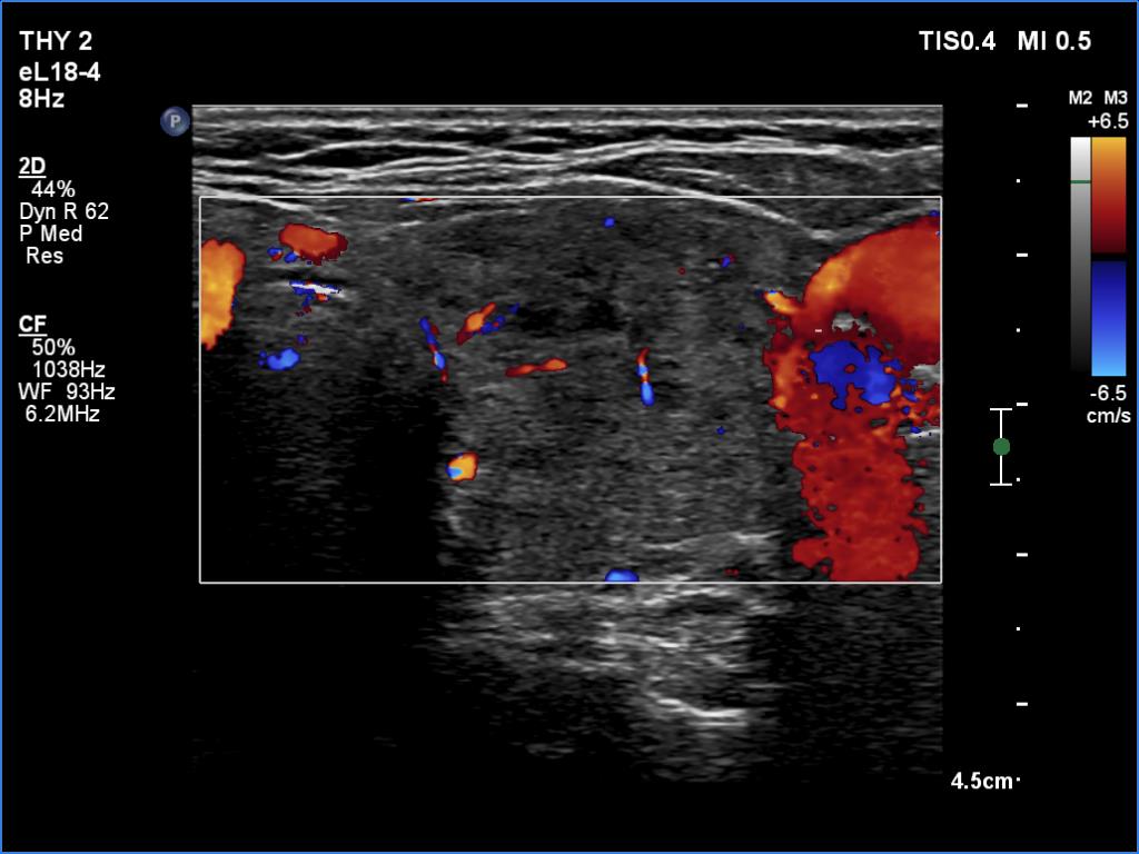 Right lobe, longitudinal scan